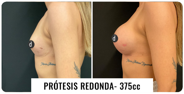 antes-despues-aumento-de-pecho-7-1-1